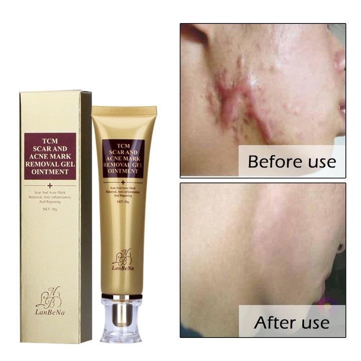 TCM Scar and Acne Remover Gel
